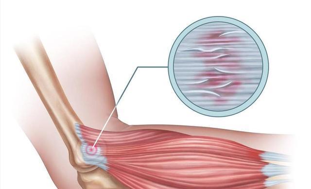 陈方, 么回事, 在肱骨外髁 陈方, 么回事, 在肱骨外髁